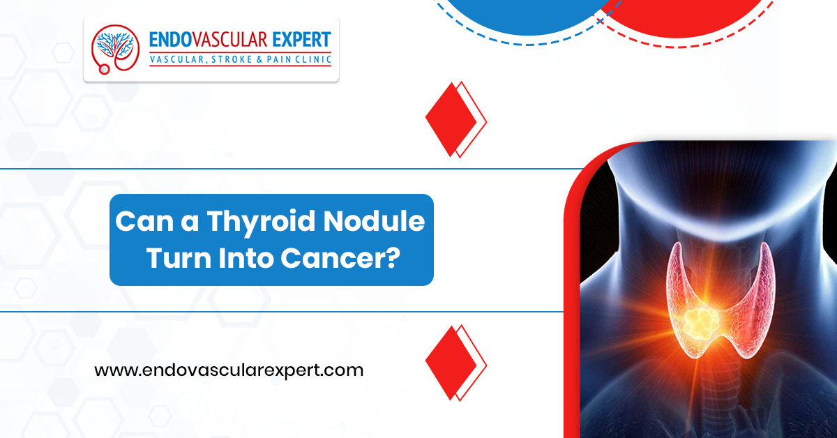 Can a Thyroid Nodule Turn Into Cancer? 2 Thyroid Nodule Turn Into Cancer