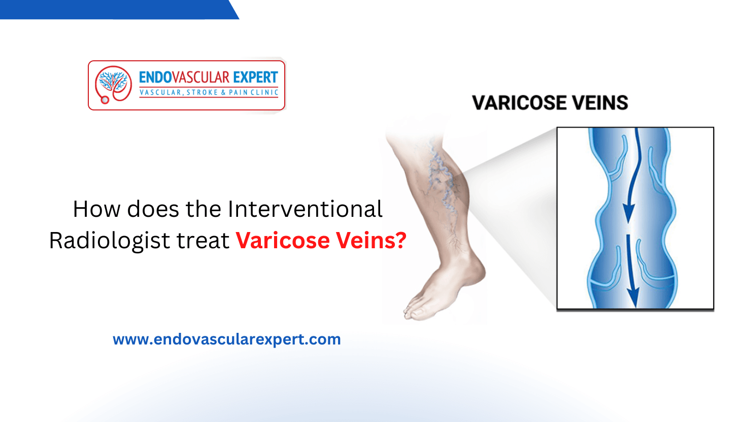 How does the Interventional Radiologist treat Varicose Veins