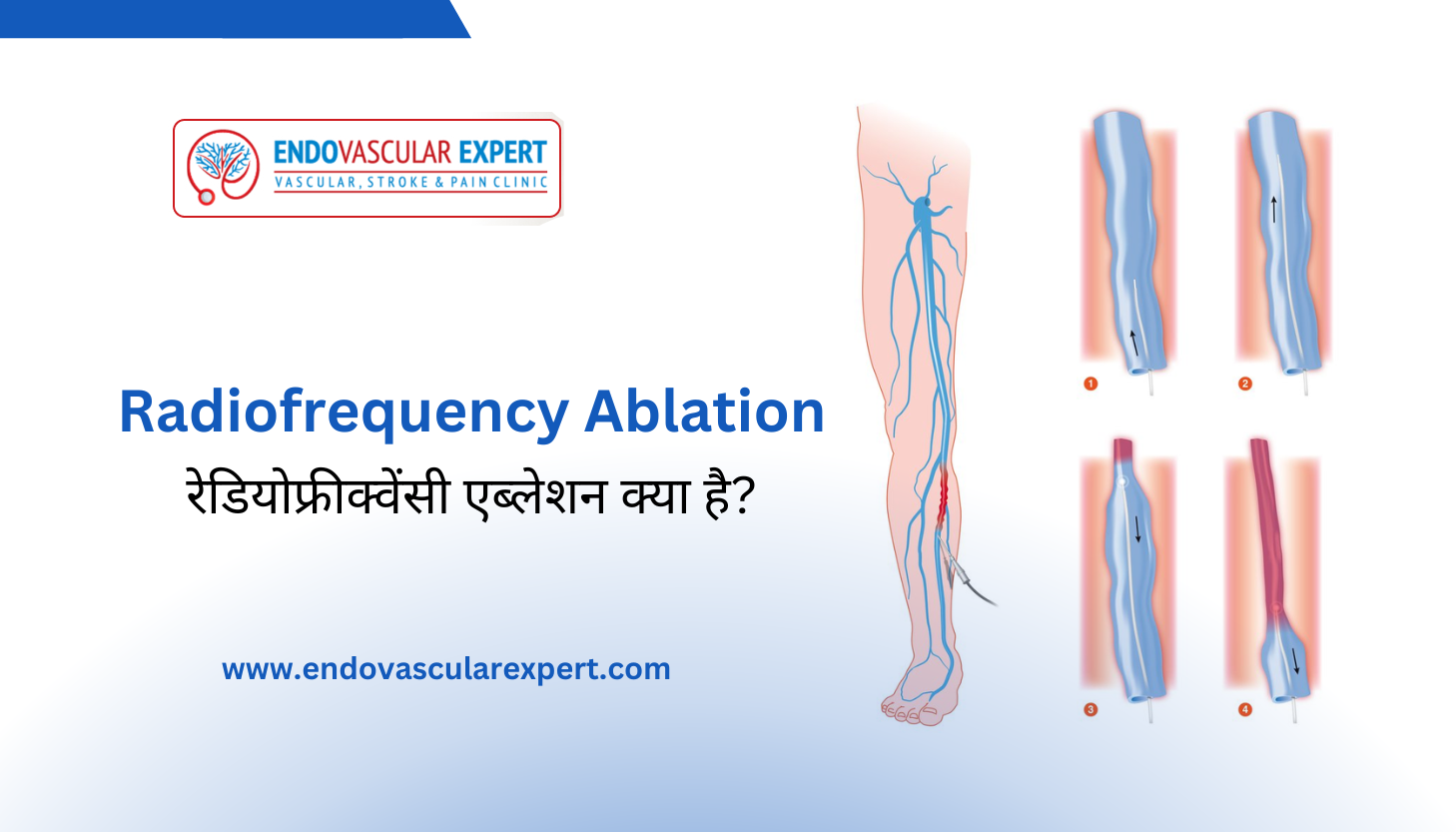 What is Radiofrequency ablation in Hindi