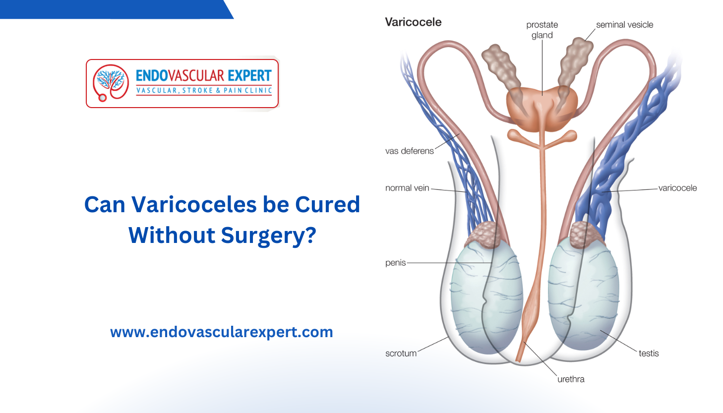 Can Varicoceles be Cured Without Surgery