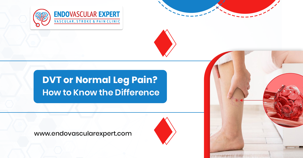 DVT or Normal Leg Pain? How to Know the Difference 2 DVT or Normal Leg Pain