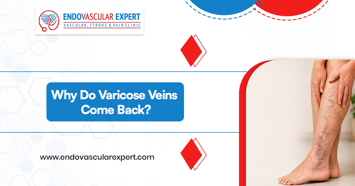 Why Do Varicose Veins Come Back? 2 Do Varicose Veins Come Back