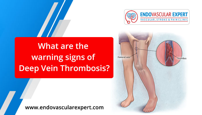 What are the warning signs of Deep vein thrombosis?