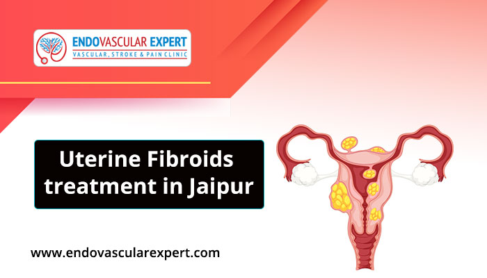 Uterine Fibroids treatment in Jaipur