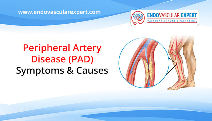 Peripheral artery disease: symptoms and causes