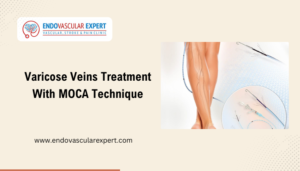 Varicose Veins Treatment With MOCA Technique - Dr. Nikhil Bansal
