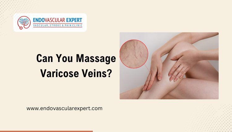 Can You Massage Varicose Veins