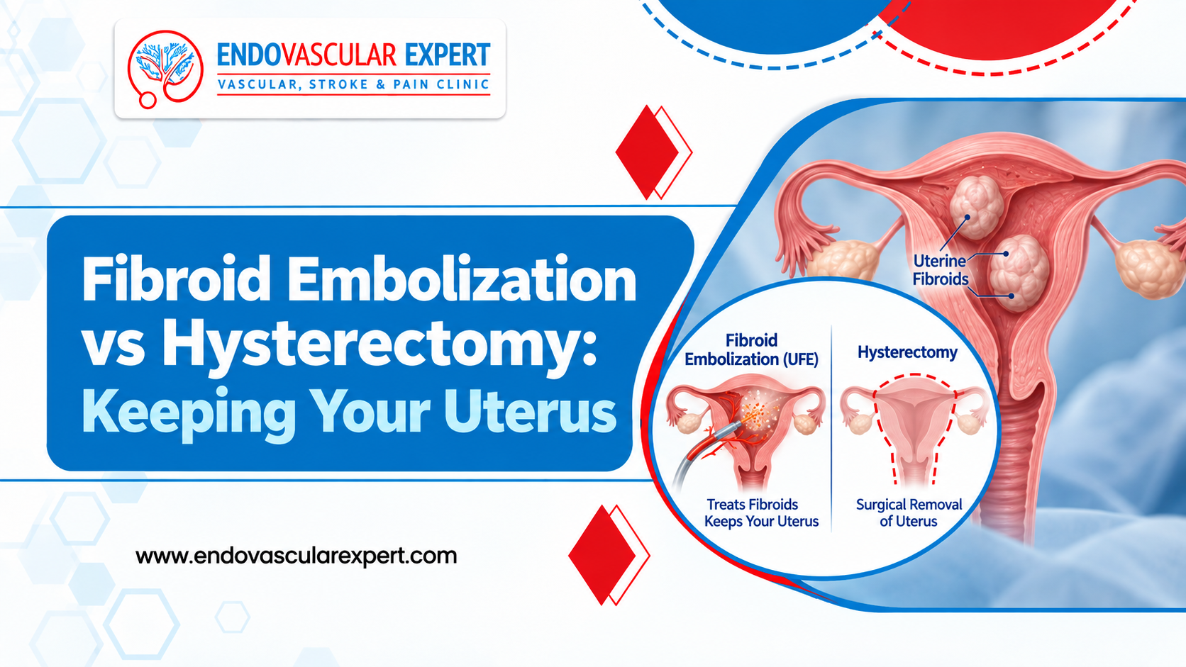 Fibroid Embolization vs Hysterectomy: Keeping Your Uterus 2 Fibroid Embolization vs Hysterectomy