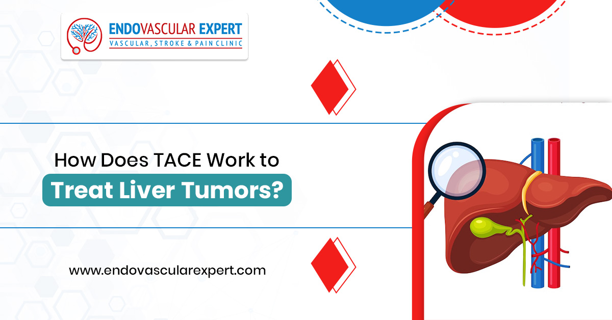 How Does TACE Work to Treat Liver Tumors