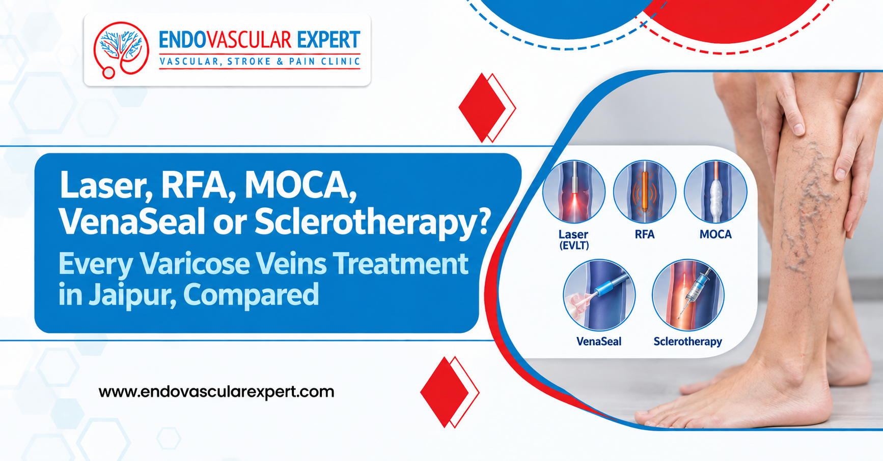 Laser, RFA, MOCA, VenaSeal or Sclerotherapy? Every Varicose Veins Treatment in Jaipur, Compared 2 Laser RFA MOCA VenaSeal or Sclerotherapy