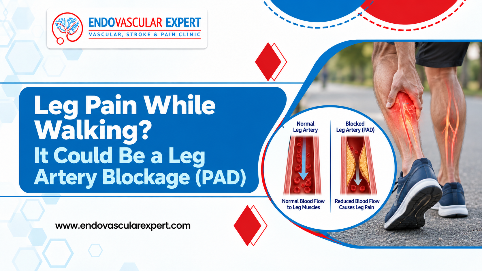 Leg Pain While Walking? It Could Be a Leg Artery Blockage (PAD) 2 Leg Artery Blockage