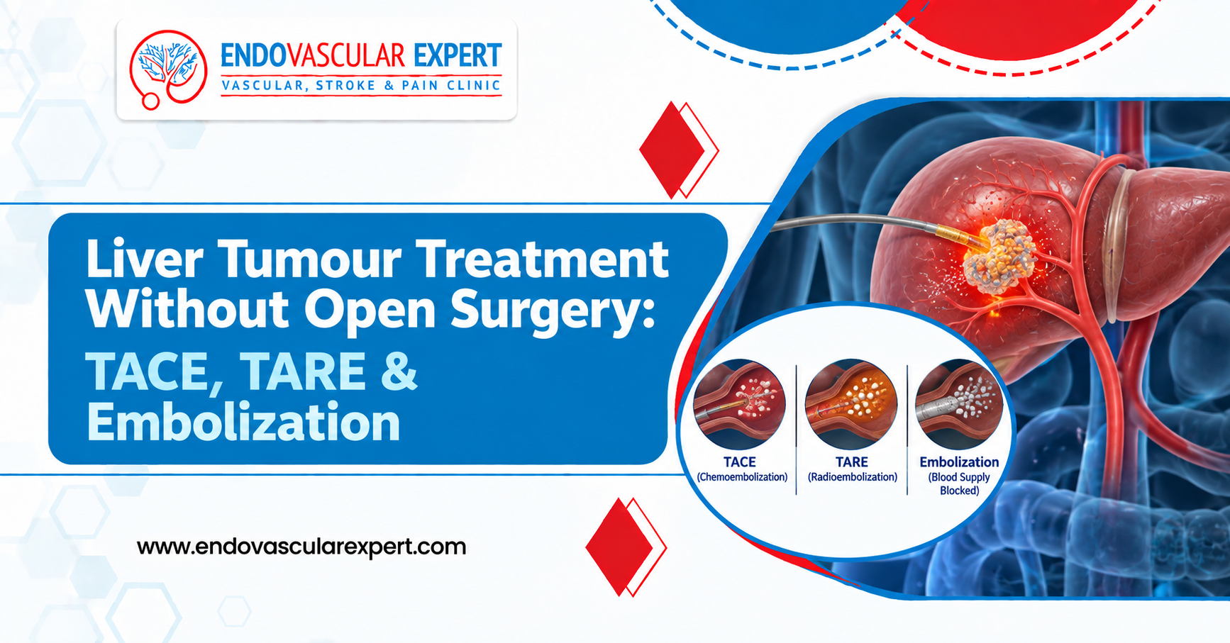 Liver Tumour Treatment Without Open Surgery: TACE, TARE & Embolization Explained 2 Liver Tumour Treatment Without Open Surgery