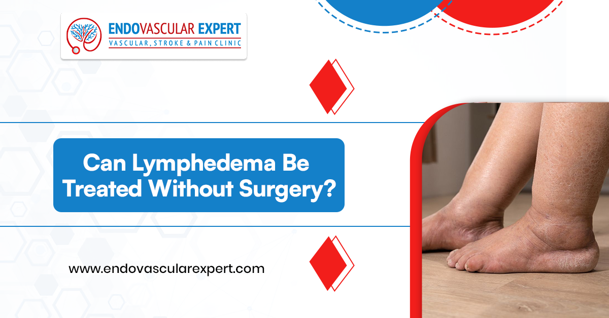 Can Lymphedema Be Treated Without Surgery? 2 Lymphedema Be Treated Without Surgery