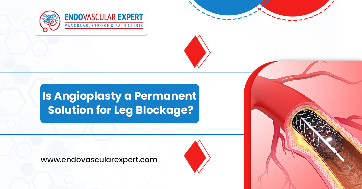 Is Angioplasty a Permanent Solution for Leg Blockage? 2 Permanent Solution for Leg Blockage