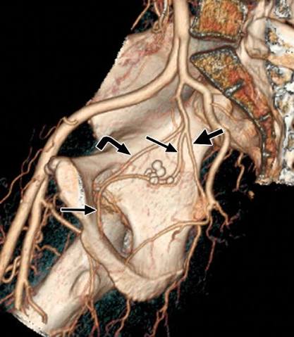 Pudendal Artery Angioplasty and Stenting 1 Pudendal Artery Angioplasty in Jaipur