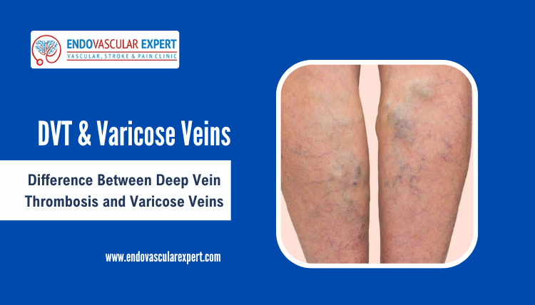 Diffеrеncе Bеtwееn Deep Vein Thrombosis and Varicose Veins
