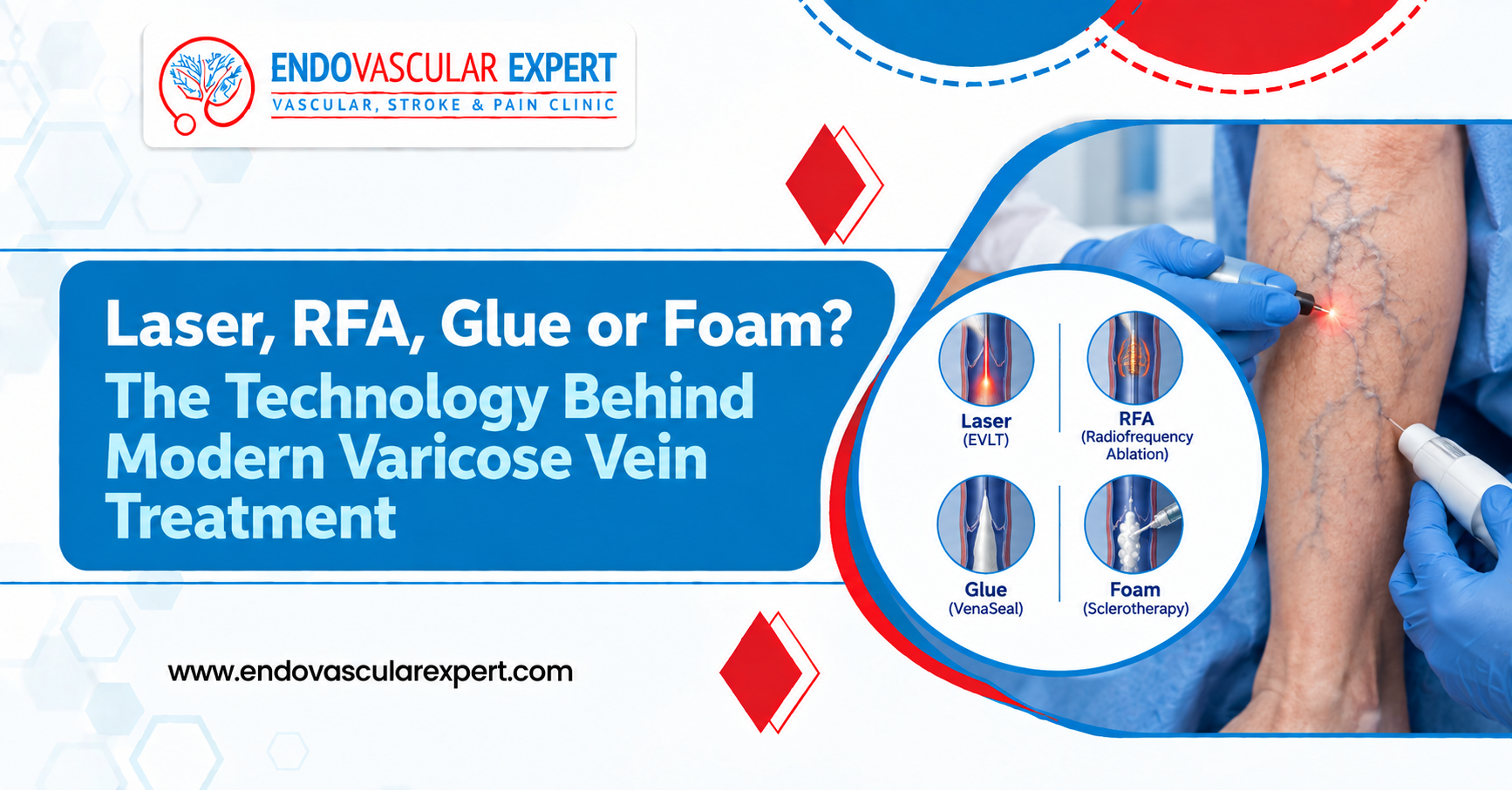 Laser, RFA, Glue or Foam? The Technology Behind Modern Varicose Vein Treatment 2 Technology Behind Modern Varicose Vein Treatment
