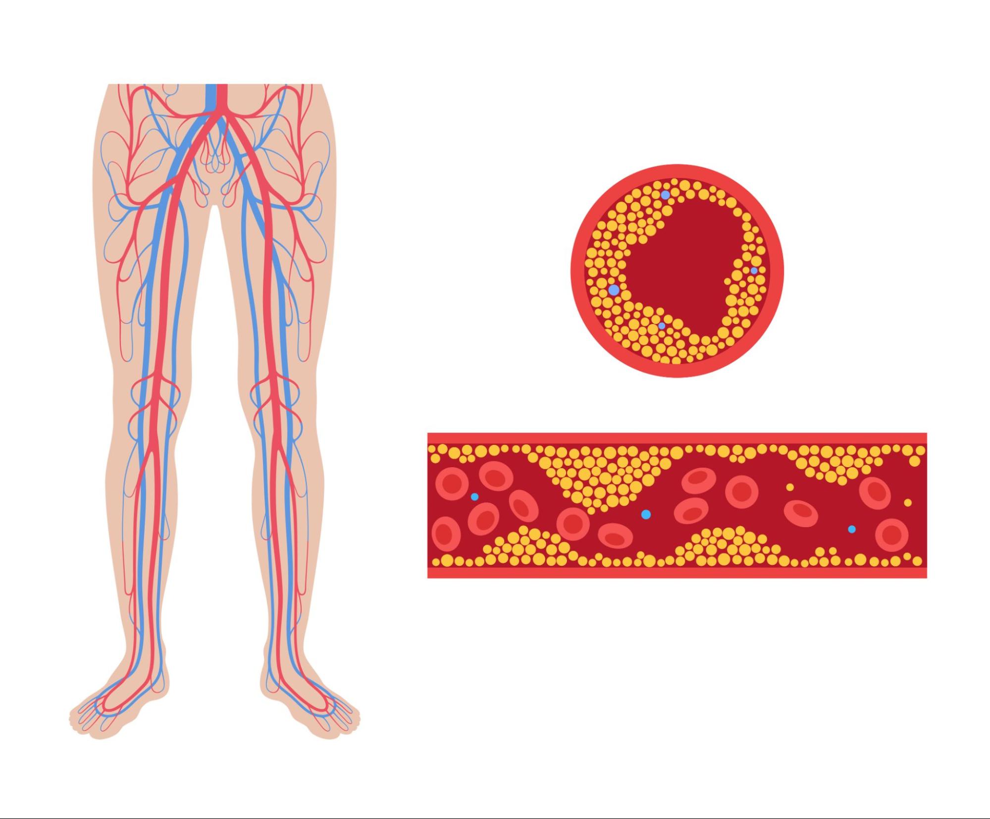 Treatment of vascular disease