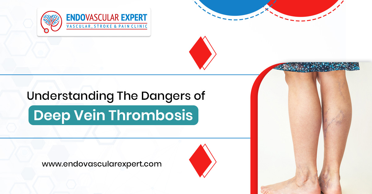 Understanding The Dangers of Deep Vein Thrombosis