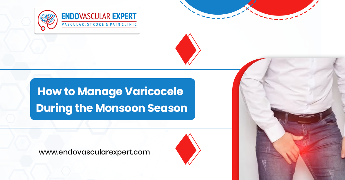 How to Manage Varicocele During the Monsoon Season 2 Varicocele During the Monsoon Season