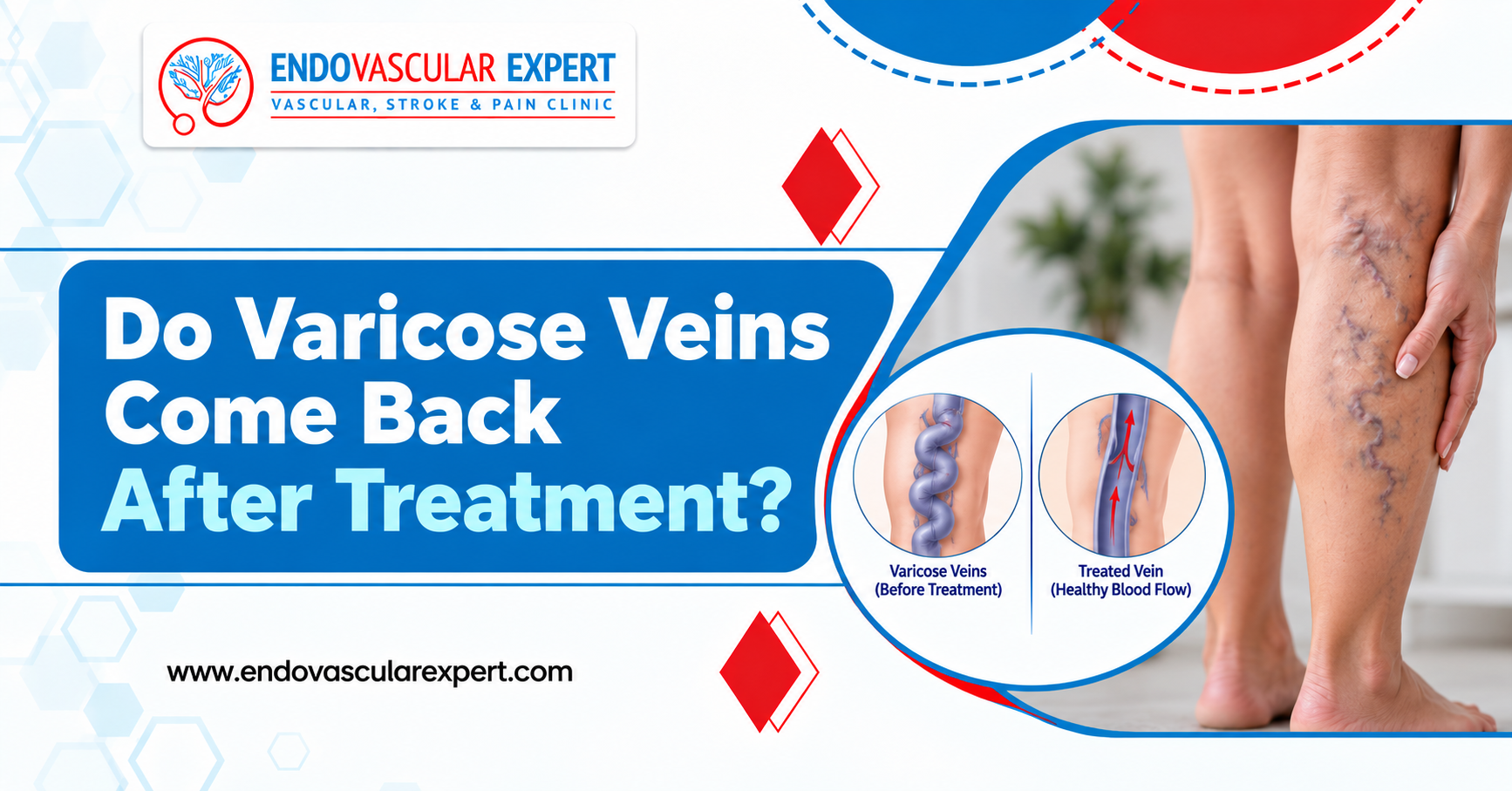 Do Varicose Veins Come Back After Treatment? An Honest, Data-Backed Answer 2 Varicose Veins Come Back After Treatment