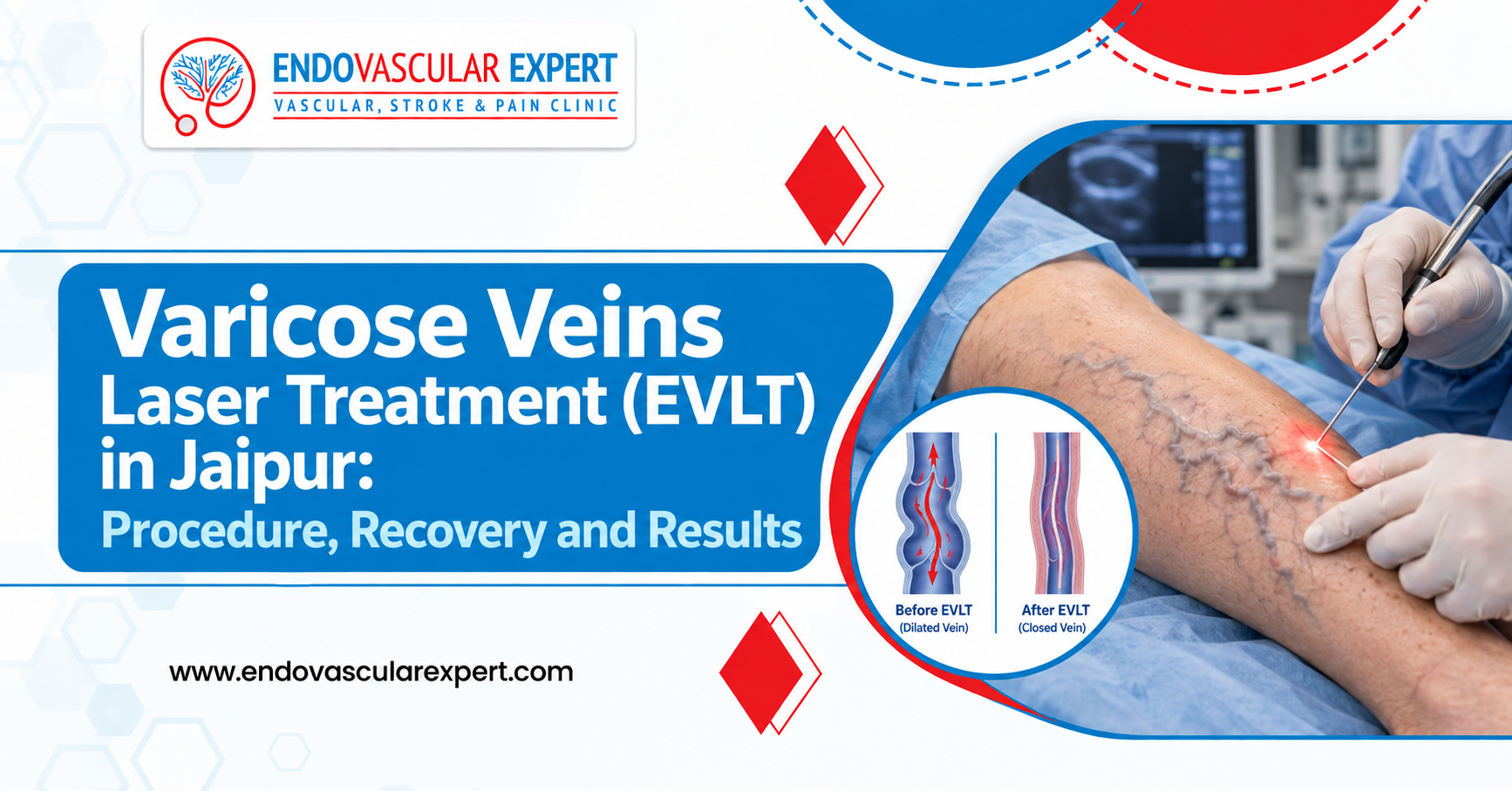 Varicose Veins Laser Treatment (EVLT) in Jaipur: Procedure, Recovery and Results 2 Varicose Veins Laser Treatment