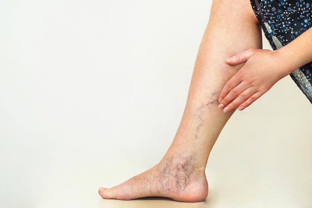Home 11 Varicose Veins