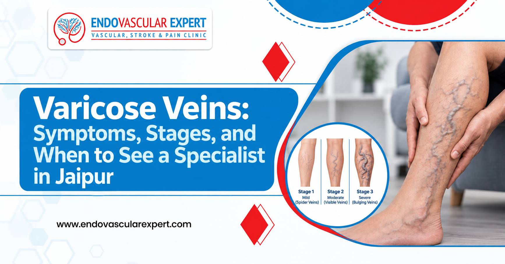 Varicose Veins: Symptoms, Stages, and When to See a Specialist in Jaipur 2 Varicose Veins