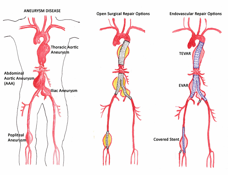 vascular diseases