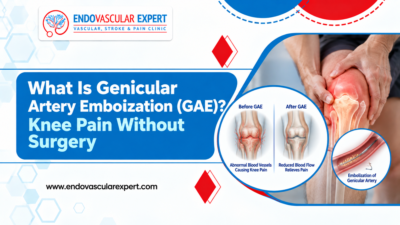 Knee Pain Without Surgery: What Is Genicular Artery Embolization (GAE)? 2 What Is Genicular Artery Embolization