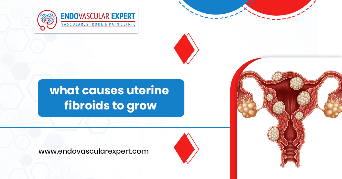 What Causes Uterine Fibroids to Grow? 2 Causes of Uterine Fibroids Growth