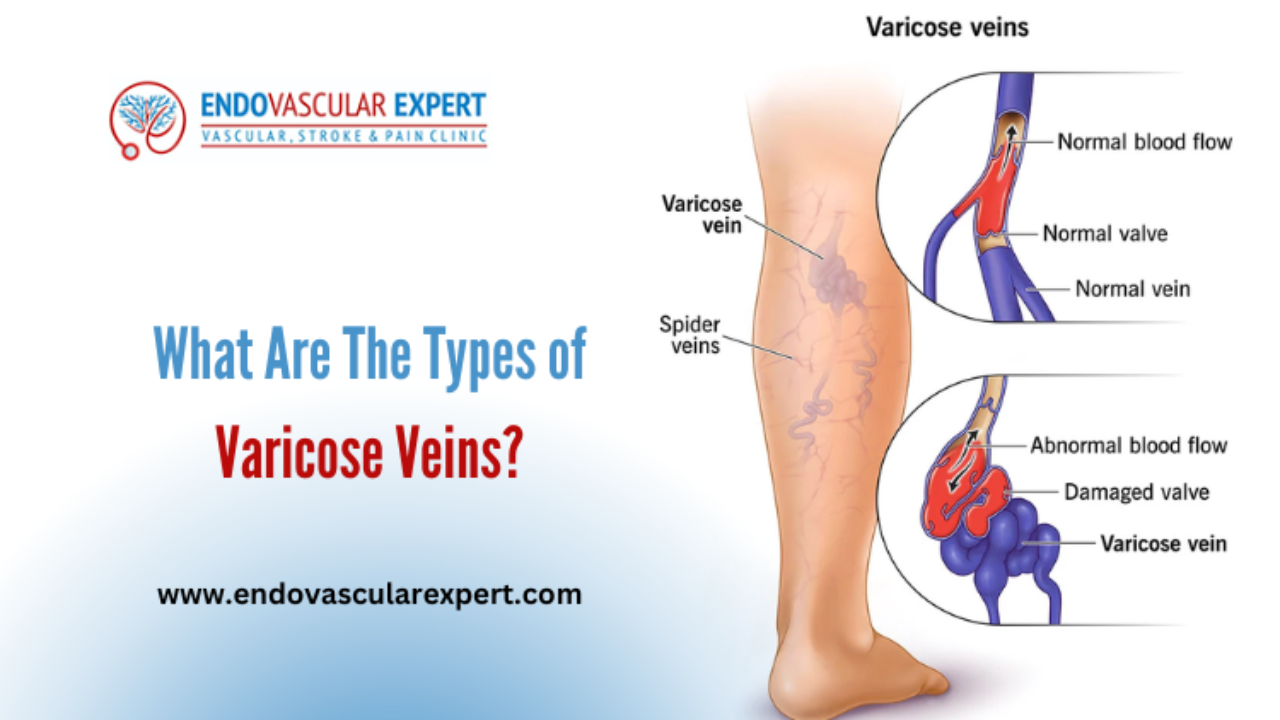 Varcises Varicose Veins Varices En Ingles - Infoupdate.org