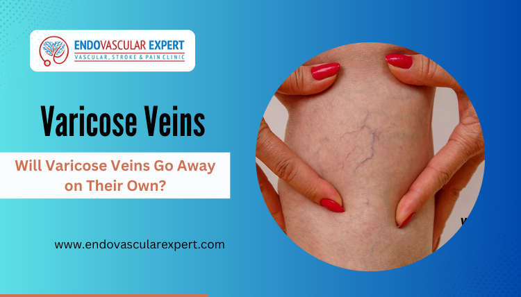 Will Varicose Veins Go Away on Their Own