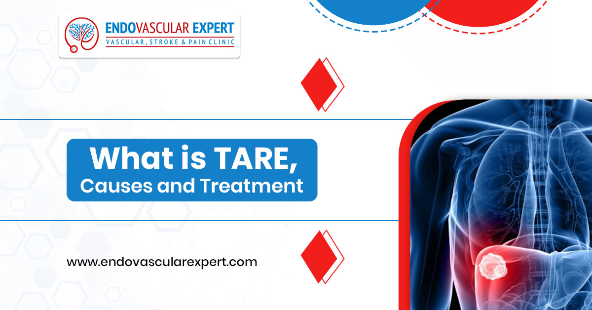What is TARE, Causes and Treatment
