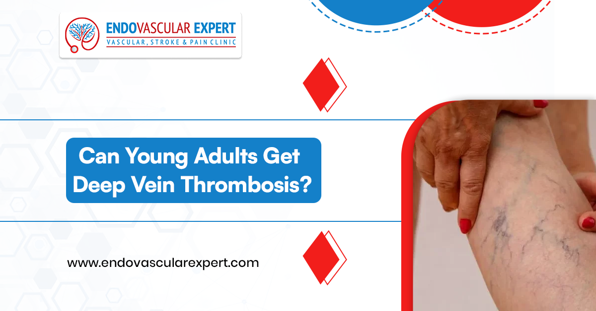 Can Young Adults Get Deep Vein Thrombosis? 2 Young Adults Get Deep Vein Thrombosis