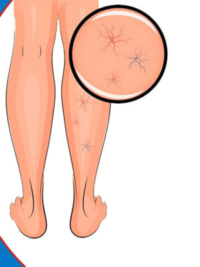 Varicose veins