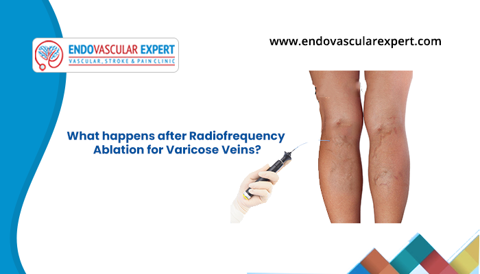 What happens after radiofrequency ablation for varicose veins?