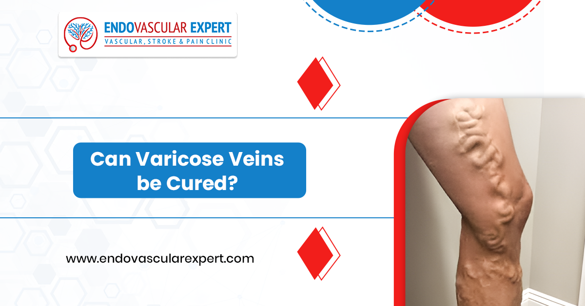 Can varicose veins be cured