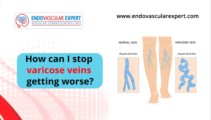 varicose veins treatment
