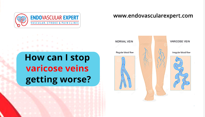 How to Prevent Varicose Veins from Worsening