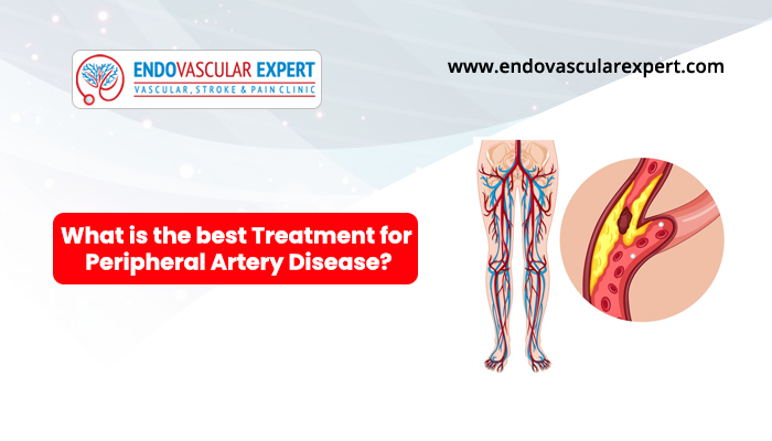 best treatment for peripheral artery disease