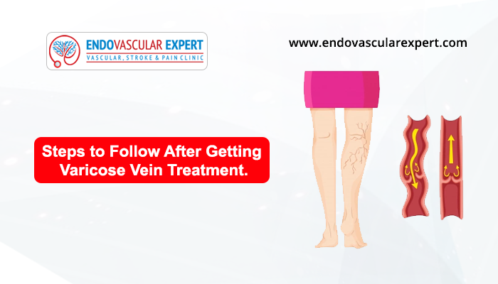 Steps to follow after getting varicose vein treatment