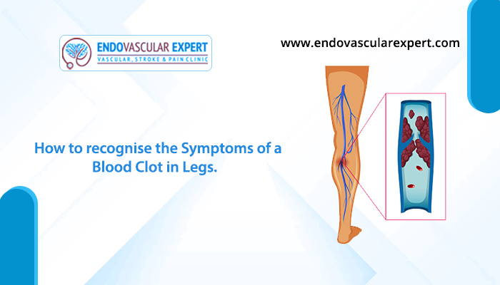 symptoms of a blood clot