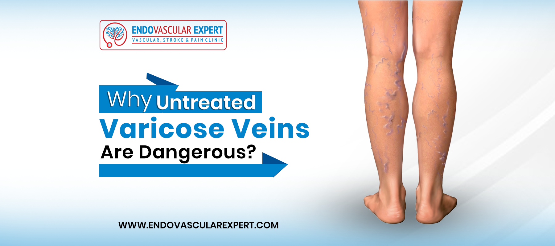 Why Untreated Varicose Veins Are Dangerous