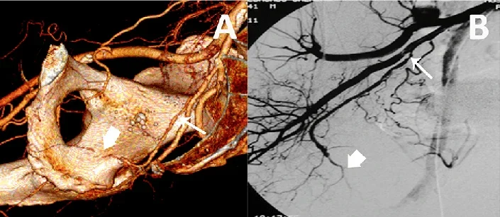 Pudendal Artery Angioplasty and Stenting 13 Causes and Risk Factors of Pudendal Artery Angioplasty