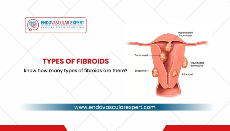 Types of Fibroids - Know How Many Types of Fibroids? [2022]
