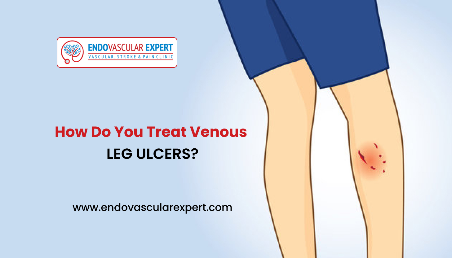 How Do You Treat Venous Leg Ulcers