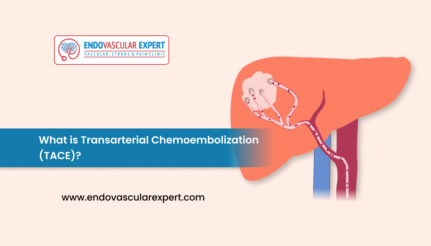 What is Transarterial Chemoembolization