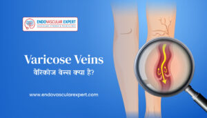 Varicose Veins in Hindi: वैरिकोज वेन्स क्या है? | Endovascularexpert Clinic
