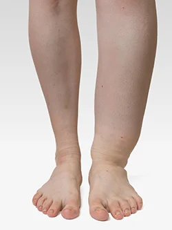 lymphedema leg